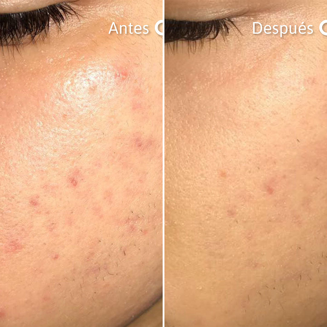 Niacik Serum Alpha Arbutin + Niacinamida Reduce Manchas, Elimina Puntos Negros y Control Grasa