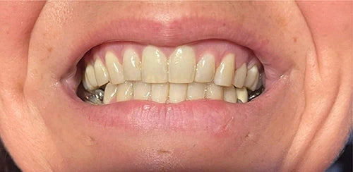 Ejemplo visual de tono dental desigual